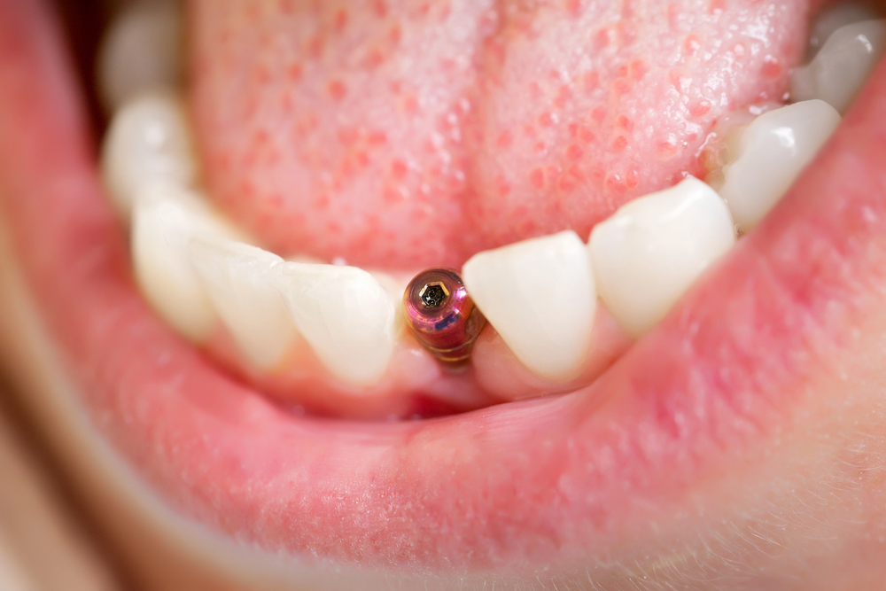 customised dental implants